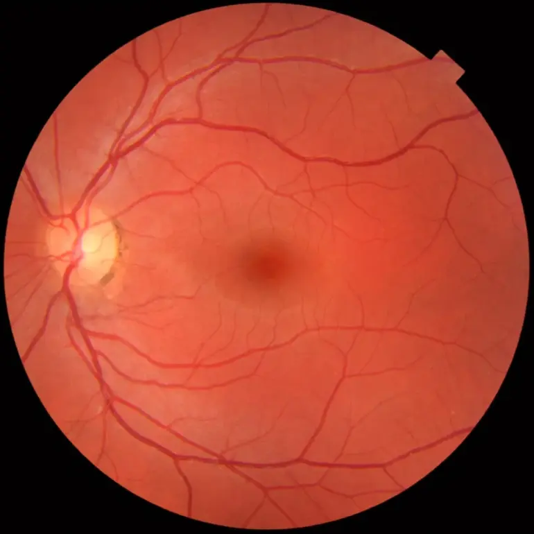 Snímek sítnice z fundus kamery – screening očního pozadí
